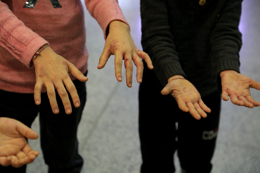 Children of the Iraqi migrants show hands with wounds and infections to the members of the media as they arrive to the airport in Irbil, Iraq, early Friday, Nov. 26, 2021. A second group of Iraqis have returned home in repatriation flights after a failed bid to enter Europe. Over 170 people returned on a flight that landed in Irbil airport in the northern Kurdish-run region Friday morning.