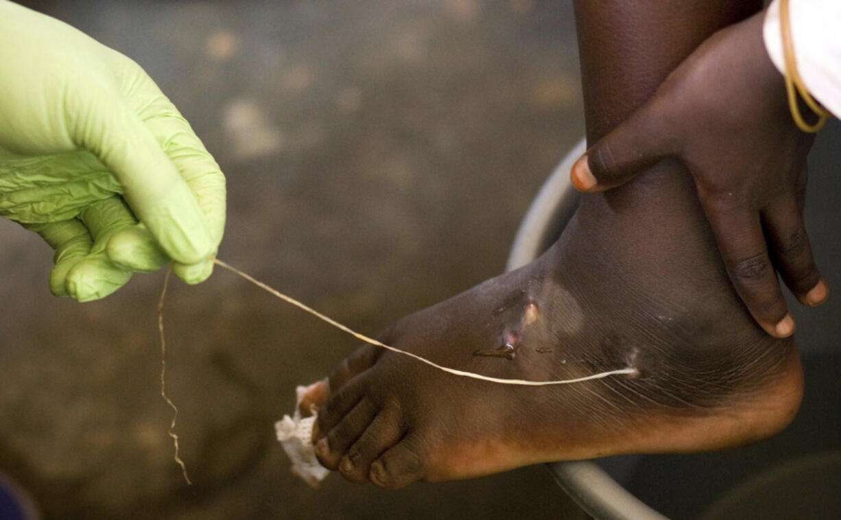 FILE - In this March 9, 2007, file photo, a Guinea worm is extracted by a health worker from a child's foot at a containment center in Savelugu, Ghana. The number of people infected with Guinea worm dropped to just over a dozen worldwide in 2021 as health workers try to eradicate the disease.