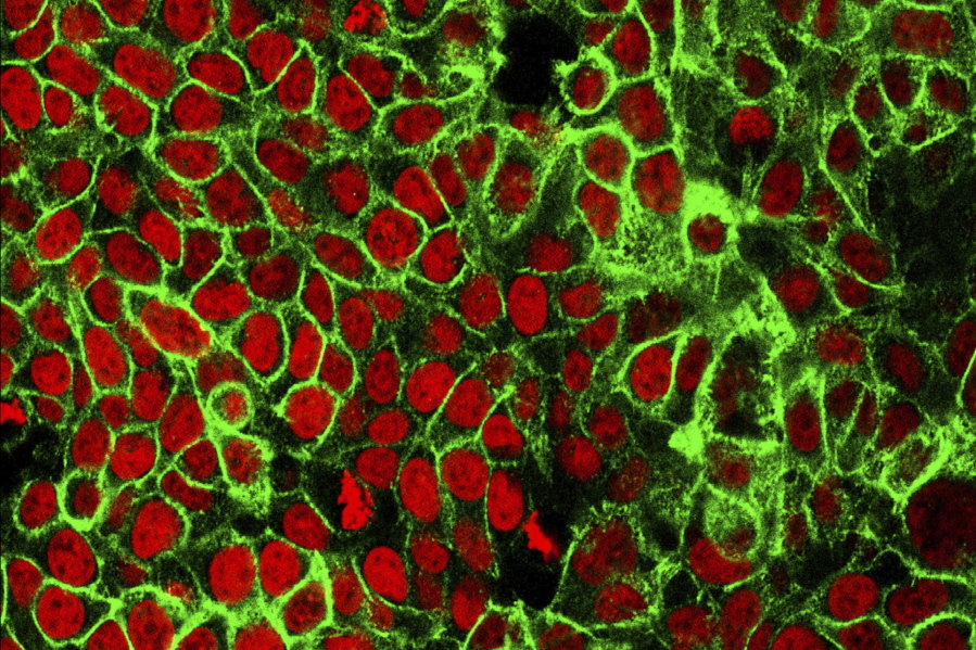 FILE - This microscope image made available by the National Cancer Institute Center for Cancer Research in 2015 shows human colon cancer cells with the nuclei stained red. Cancer is a disease of the genome, or full set of instructions for running cells, that occurs when changes in a person's DNA cause cells to grow and divide uncontrollably.
