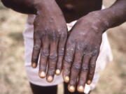 This 1997 image provided by the CDC  during an investigation into an outbreak of monkeypox, which took place in the Democratic Republic of the Congo (DRC), formerly Zaire, and depicts the dorsal surfaces of the hands of a monkeypox case patient, who was displaying the appearance of the characteristic rash during its recuperative stage. As more cases of monkeypox are detected in Europe and North America in 2022, some scientists who have monitored numerous outbreaks in Africa say they are baffled by the unusual disease's spread in developed countries.