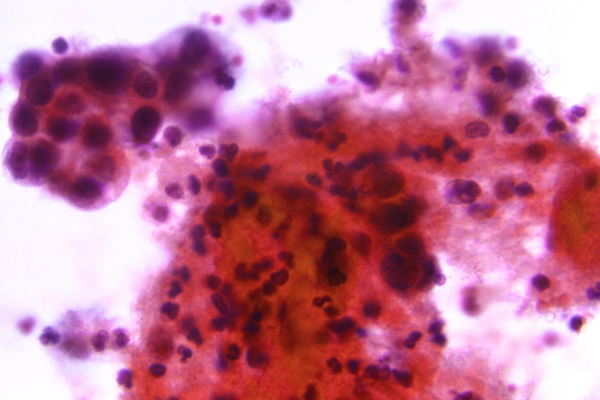 This undated microscope photo made available by the Centers for Disease Control and Prevention shows the results of a Papanicolaou test, or Pap test, with a positive indication for the presence of uterine cervical adenocarcinoma, classified as Stage-III. According to a study published in the journal JAMA Oncology on Thursday, May 5, 2022, researchers found that overall uterine cancer death rates in the U.S., increased by 1.8% per year from 2010 to 2017.