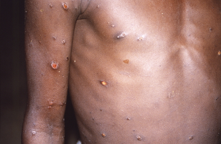 FILE - This 1997 image provided by U.S. Centers for Disease Control and Prevention shows the right arm and torso of a patient, whose skin displayed a number of lesions due to what had been an active case of monkeypox. As health authorities in Europe and elsewhere roll out vaccines and drugs to stamp out the biggest monkeypox outbreak beyond Africa, in 2022, some doctors are acknowledging an ugly reality: The resources to slow the disease's spread have long been available, just not to the Africans who have dealt with it for decades.