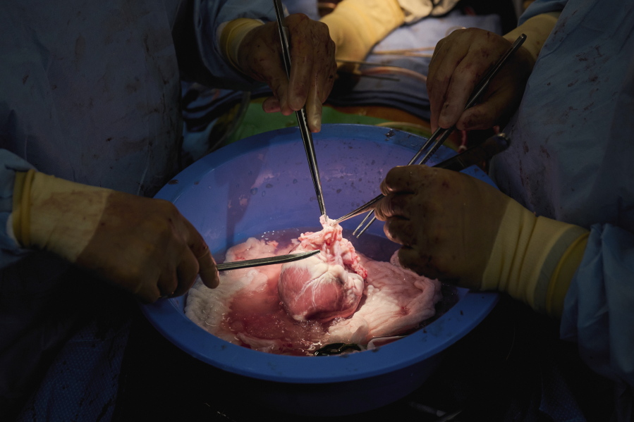 In this photo provided by NYU Langone Health, surgeons prepare a genetically modified pig heart for transplant into a recently deceased donor at NYU Langone Health on Wednesday, July 6, 2022, in New York. Experiments are raising new hope that pigs might one day help fill a shortage of donated organs -- at least, for people who need a new heart or kidney.