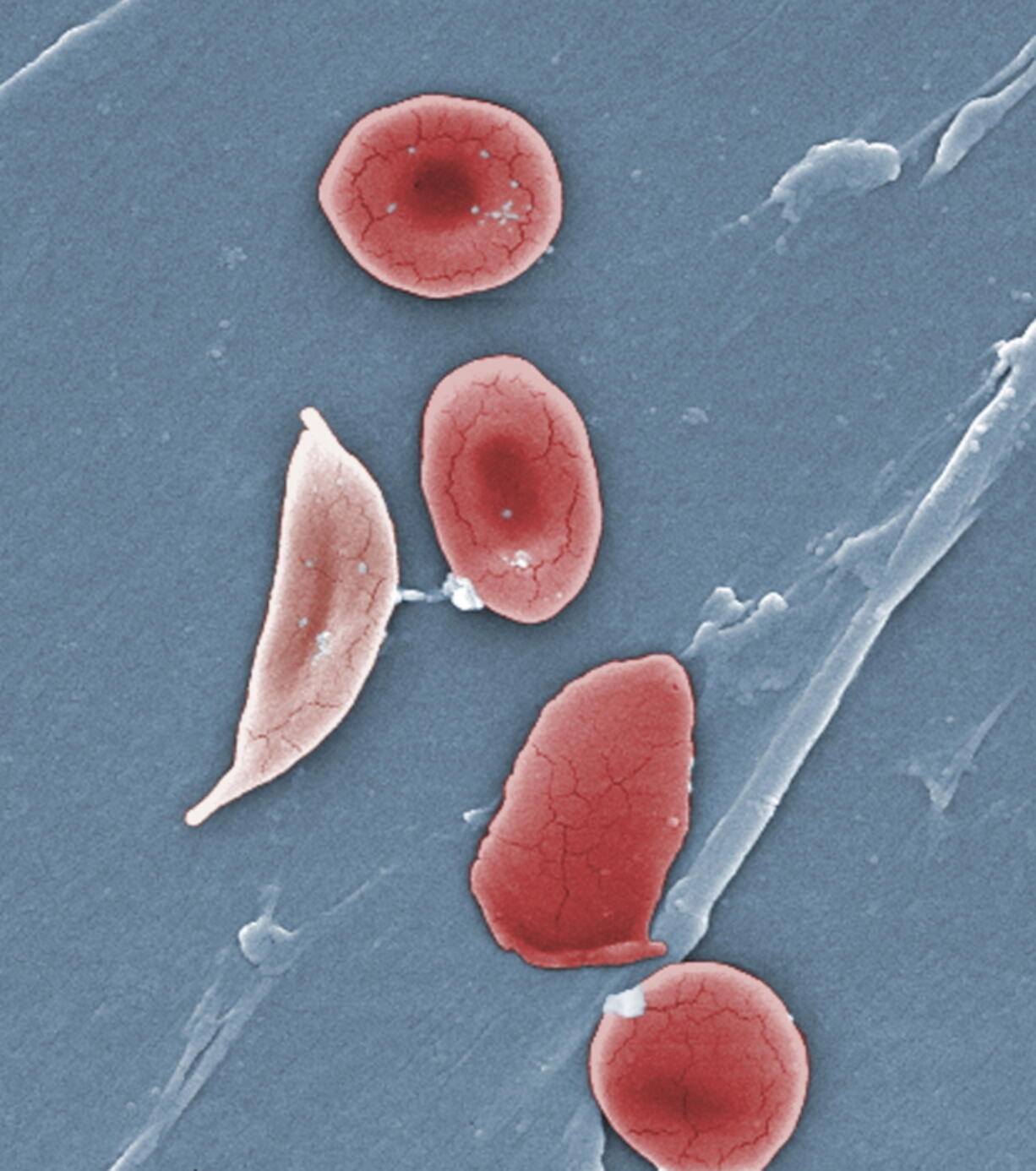 FILE - This 2009 colorized microscope image made available by the Sickle Cell Foundation of Georgia via the Centers for Disease Control and Prevention shows a sickle cell, left, and normal red blood cells of a patient with sickle cell anemia. A study of U.S. children with sickle cell disease found fewer than half get a needed screening for stroke, a common complication. And only about half or fewer get a treatment that can help with pain and anemia, the study found. The Centers for Disease Control and Prevention released the study Tuesday, Sept. 20, 2022, and called for more screening and treatment.