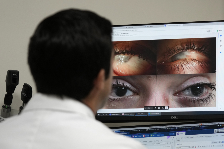 Dr. Alfonso Sabater, left, pulls up photos of Antonio Vento Carvajal's eyes photographed before and after surgery and gene therapy, Thursday, July 6, 2023, at University of Miami Health System's Bascom Palmer Eye Institute in Miami. Antonio was born with dystrophic epidermolysis bullosa, a rare genetic condition that causes blisters all over his body and in his eyes. He was blind for much of his life but can see again after getting gene therapy eyedrops.