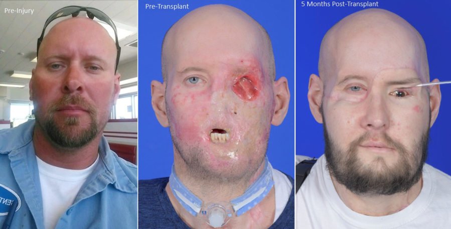 This combination of photos provided by NYU Langone Health in November 2023 shows Aaron James before and after his high-voltage electricity accident and after a facial and eye transplant. The NYU team announced Thursday, Nov. 9, 2023, that so far, James is recovering well from the dual transplant in May and the donated eye looks remarkably healthy.