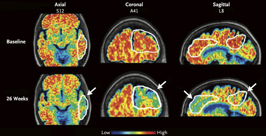 These PET scan images provided by the New England Journal of Medicine in January 2024 show a reduction in amyloid-beta levels in an Alzheimer&rsquo;s patient after focused ultrasound treatment to open the blood-brain barrier after 26 weeks. Red is associated with higher levels of amyloid-beta levels. Scientists have found a way to help Alzheimer&rsquo;s drugs seep inside the brain faster _ by temporarily breaching its protective shield.