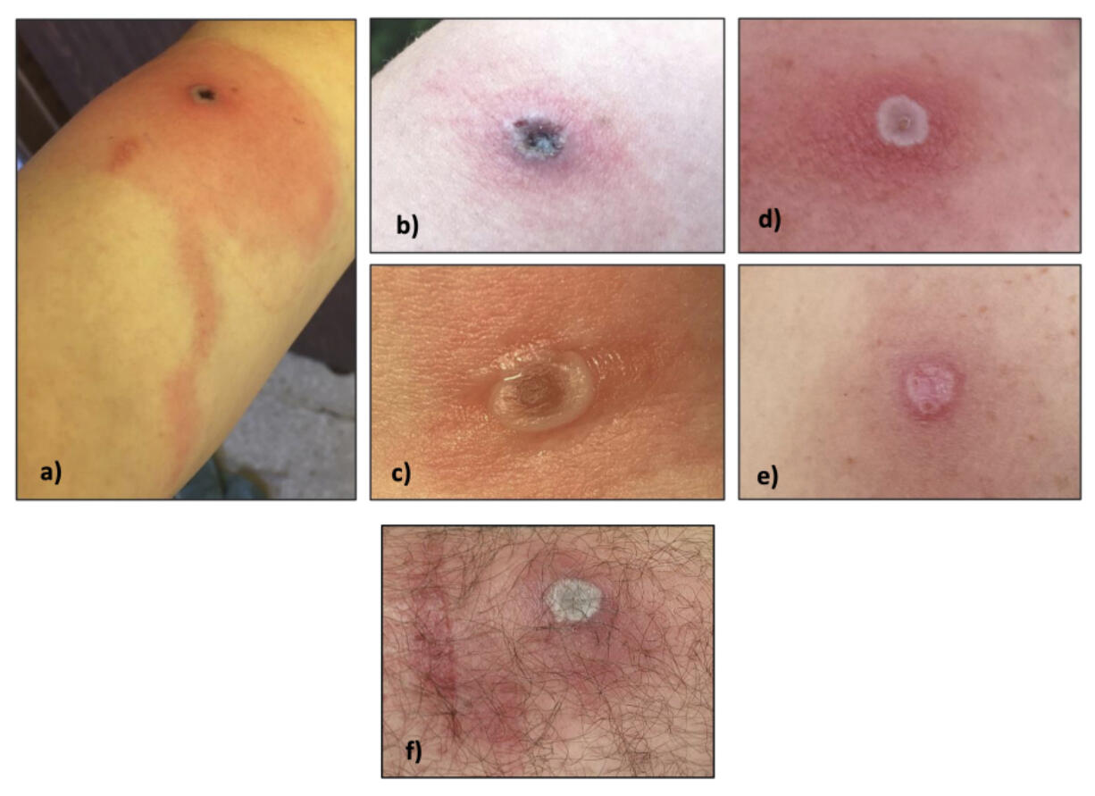 This image provided by the Alaska Department of Health shows several Alaskapox lesions. &ldquo;A&rdquo; is a lesion about 10 days after symptom onset, and &ldquo;B&rdquo; is the same lesion two days later. &ldquo;C&rdquo; is a lesion about 5 days after symptom onset, about 1.2 cm across. &ldquo;D&rdquo; is a lesion about 5 days after symptom onset, about 1 cm across, and &ldquo;E&rdquo; is same lesion about 4 weeks after symptom onset. &ldquo;F&rdquo; is a lesion around the reported symptom onset date. Alaskapox belongs to a family of viruses that can infect animals and humans, known as orthopoxviruses, which tend to cause lesions, or pox, on the skin.