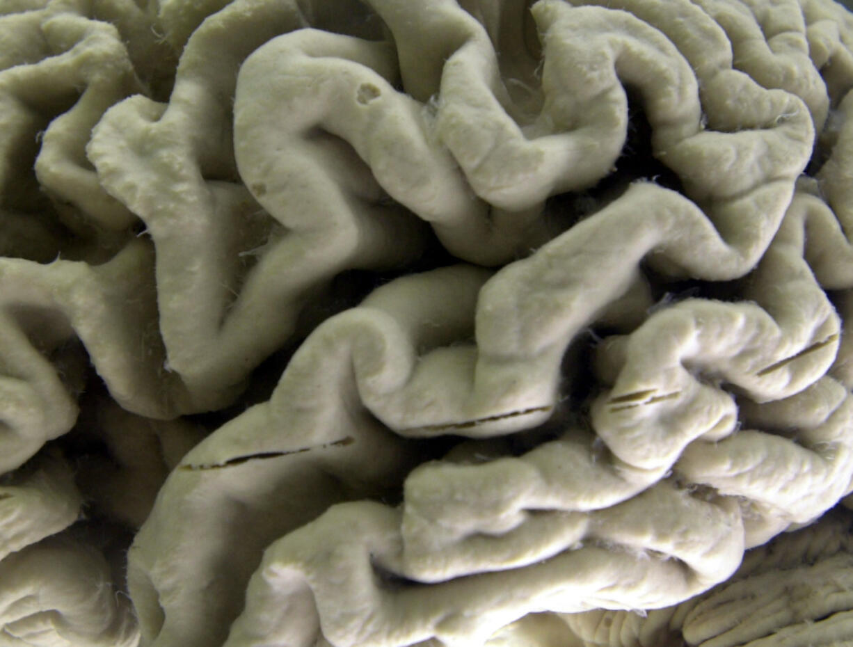 A closeup of a human brain affected by Alzheimer&rsquo;s disease, is displayed at the Museum of Neuroanatomy at the University at Buffalo in Buffalo, N.Y., on Oct. 7, 2003. According to findings published Wednesday, Feb. 21, 2024 in the New England Journal of Medicine, Alzheimer&rsquo;s quietly ravages the brain long before symptoms appear and now scientists are getting a closer look at the domino-like sequence of those changes _ a potential window to one day intervene.
