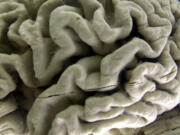 A closeup of a human brain affected by Alzheimer&rsquo;s disease, is displayed at the Museum of Neuroanatomy at the University at Buffalo in Buffalo, N.Y., on Oct. 7, 2003. According to findings published Wednesday, Feb. 21, 2024 in the New England Journal of Medicine, Alzheimer&rsquo;s quietly ravages the brain long before symptoms appear and now scientists are getting a closer look at the domino-like sequence of those changes _ a potential window to one day intervene.