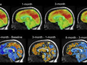 This series of PET brain scan images provided by Mount Sinai in 2024 shows changes in patient Emily Hollenbeck with deep brain stimulation therapy. Analyzing the brain activity of DBS patients, researchers found a unique pattern that reflects the recovery process.