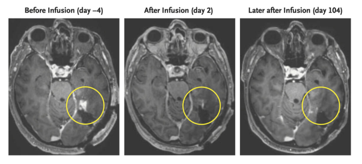 This combination of MRI scan images shows the progress of a glioblastoma patient who received CAR-T therapy which uses modified versions of T cells from a patient&rsquo;s own immune system.
