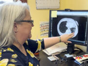 FILE - Dr. Lee Morissette shows an image of lungs damaged by asbestos exposure, at the Center for Asbestos Related Disease, Thursday, April 4, 2024, in Libby, Mont. BNSF Railway attorneys are expected to argue before jurors Friday, April 19, 2024, that the railroad should not be held liable for the lung cancer deaths of two former residents of the asbestos-contaminated Montana town, one of the deadliest sites in the federal Superfund pollution program.