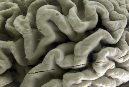 FILE - A section of a human brain with Alzheimer&rsquo;s disease is displayed at the Museum of Neuroanatomy at the University at Buffalo, in Buffalo, N.Y., Oct. 7, 2003. A long-feared gene appears to do more than raise people&Ccedil;&fnof;&Ugrave;s risk of Alzheimer&Ccedil;&fnof;&Ugrave;s: Inheriting two copies can cause the mind-robbing disease, according to research published in the journal Nature Medicine on Monday, May 6, 2024.